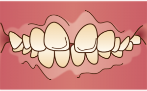 上顎前突（じょうがくぜんとつ）